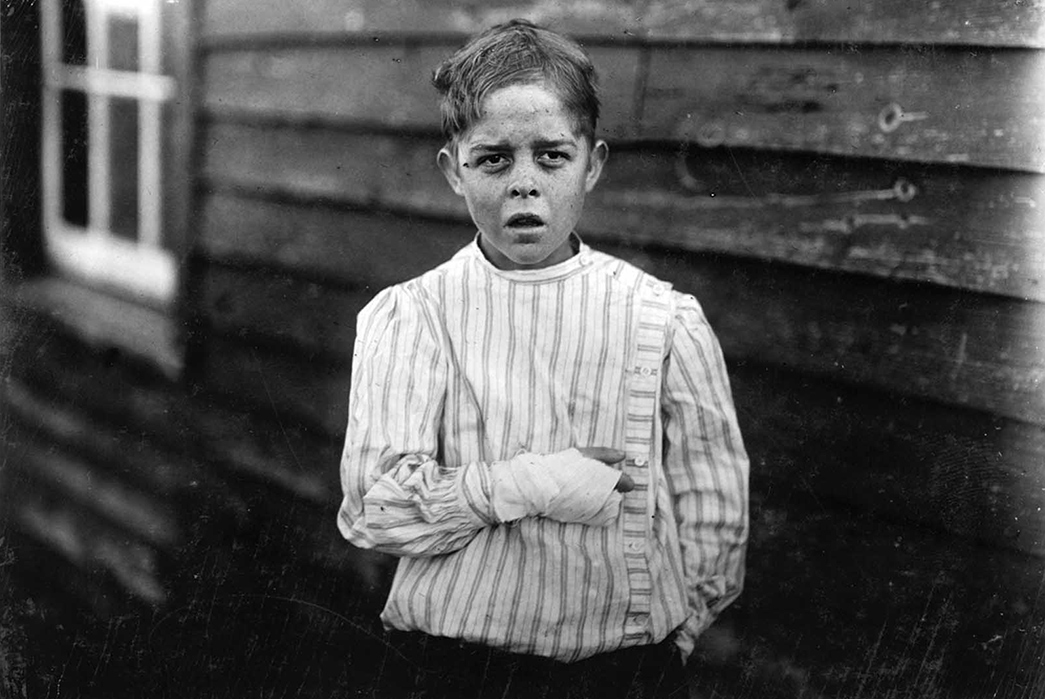 What-Ended-Child-Labor-in-the-US---Labor-Rights-History-Giles-Newsom-and-his-injured-hand.-Image-via-Library-of-Congress.
